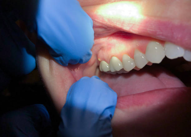 Best Emergency Gum Treatment in Lake City, IA