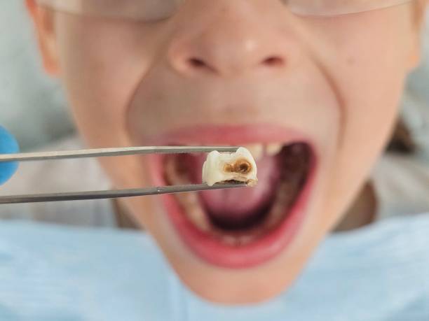 Best Emergency Dental Care for Broken or Chipped Teeth in Lake City, IA